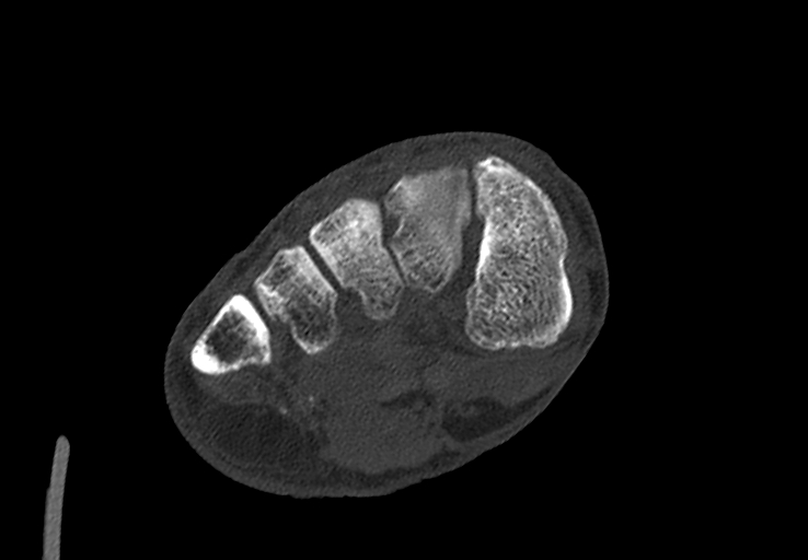 Advanced osteomyelitis due to open metatarsal fracture (Radiopaedia 83891-99095 Axial bone window 26).jpg