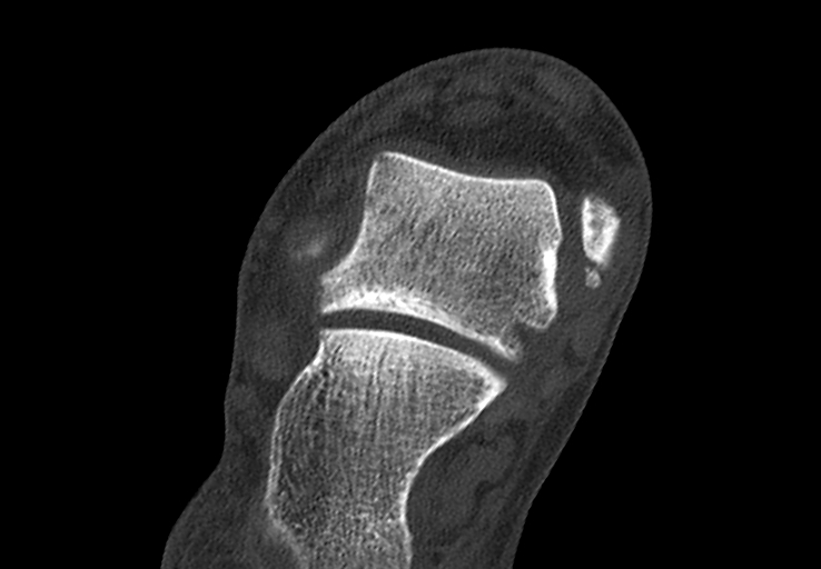 Advanced osteomyelitis due to open metatarsal fracture (Radiopaedia 83891-99095 Axial bone window 7).jpg