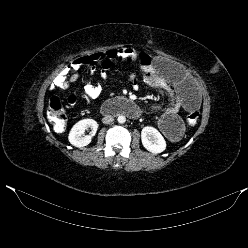 File:Afferent loop syndrome - secondary to incarcerated trocar site hernia (Radiopaedia 82959-97305 Axial C+ portal venous phase 110).jpg