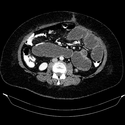 File:Afferent loop syndrome - secondary to incarcerated trocar site hernia (Radiopaedia 82959-97305 Axial C+ portal venous phase 123).jpg