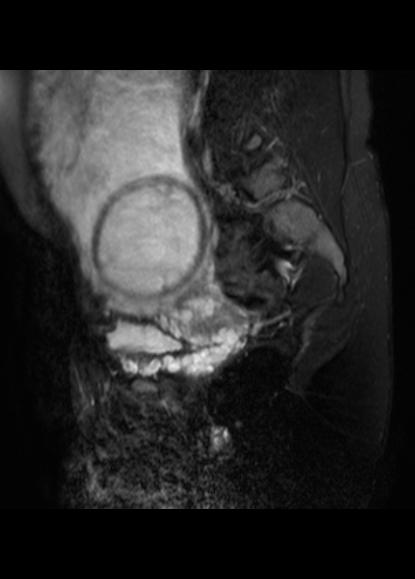 File:Aggressive angiomyxoma of the pelvis and perineum (Radiopaedia 59162-66479 Sagittal T2 fat sat 18).jpg