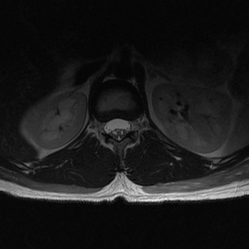File:Aggressive vertebral hemangioma (Radiopaedia 39937-42404 Axial T2 3).png