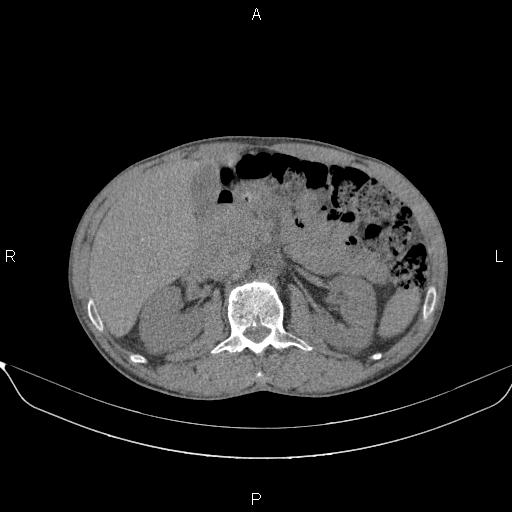 Air bronchogram in pneumonia (Radiopaedia 85719-101512 Axial non-contrast 78).jpg