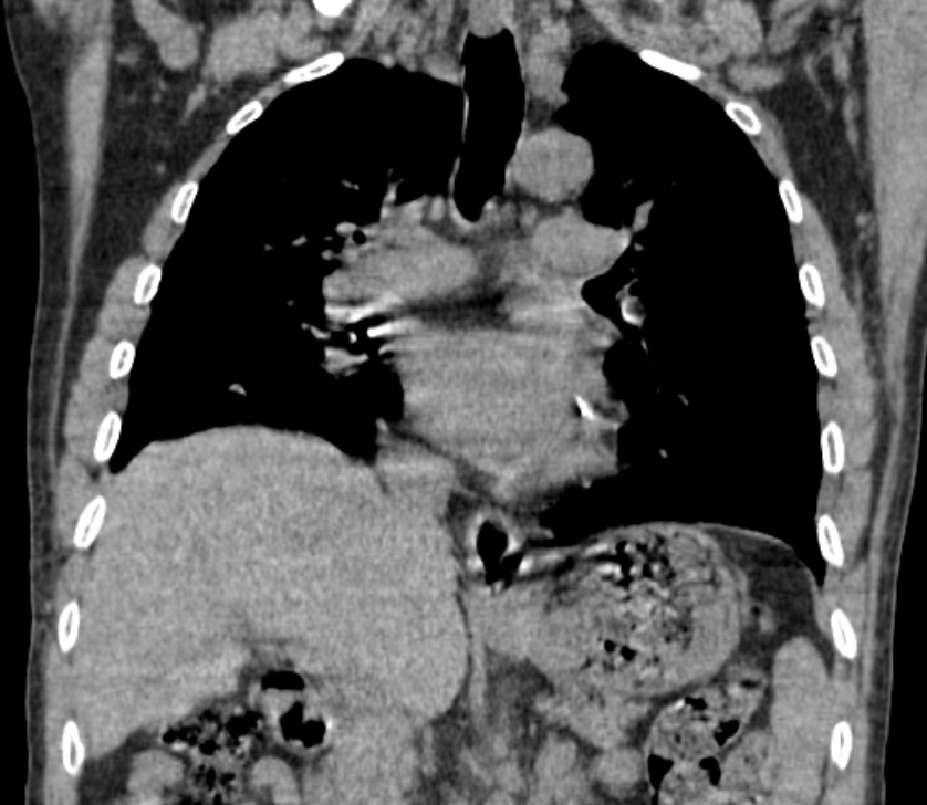 Airway foreign body in adult (Radiopaedia 85907-101779 Coronal liver window 136).jpg