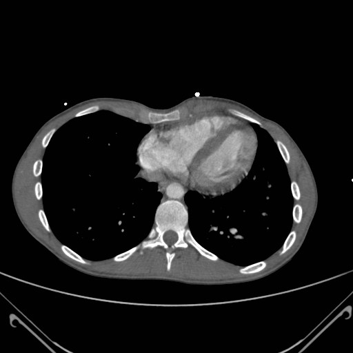 File:Alagille syndrome with pulmonary hypertension (Radiopaedia 49384-54980 A 12).jpg
