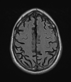 File:Alzheimer's disease- with Gerstmann syndrome and dressing apraxia (Radiopaedia 54882-61150 Axial FLAIR 22).png