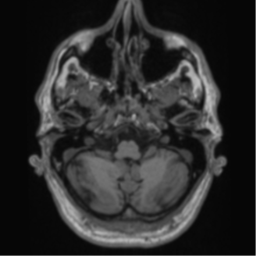 Alzheimer's disease- with Gerstmann syndrome and dressing apraxia (Radiopaedia 54882-61150 Axial T1 13).png