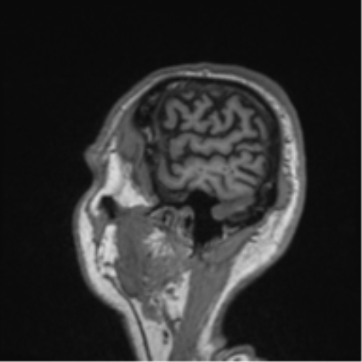 Alzheimer's disease- with Gerstmann syndrome and dressing apraxia (Radiopaedia 54882-61150 Sagittal T1 64).png