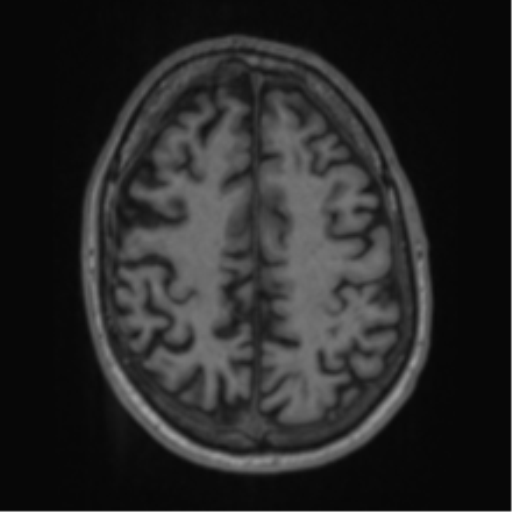 File:Alzheimer's disease- with apraxia (Radiopaedia 54763-61011 Axial T1 55).png