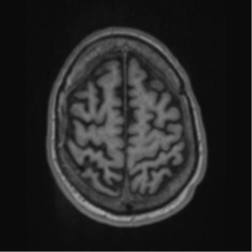 Alzheimer's disease- with apraxia (Radiopaedia 54763-61011 Axial T1 62).png