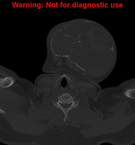 Ameloblastoma (Radiopaedia 33126-34164 Axial bone window 31).jpg
