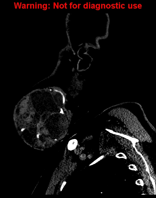 Ameloblastoma (Radiopaedia 33126-34164 F 11).jpg