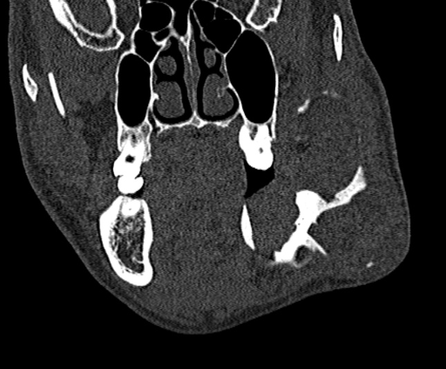 Ameloblastoma (Radiopaedia 51921-57766 Coronal bone window 99).jpg