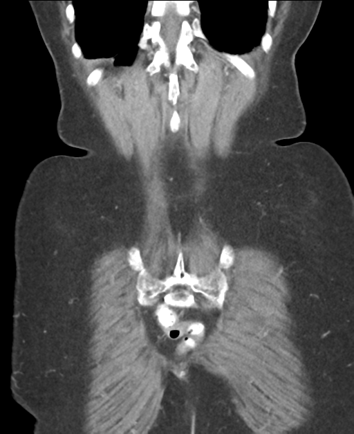 Ampullary adenocarcinoma (Radiopaedia 34013-35237 E 45).png