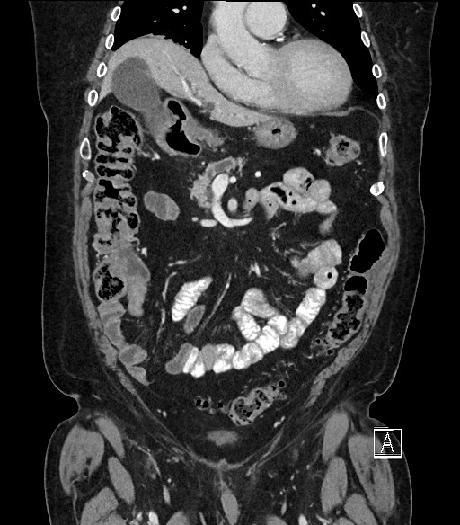 Ampullary adenocarcinoma (Radiopaedia 59373-66734 D 32).jpg