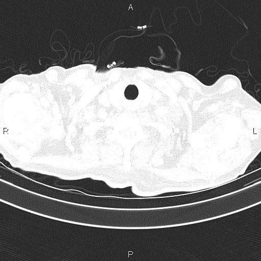 Ampullary adenocarcinoma (Radiopaedia 86093-102033 Axial lung window 11).jpg