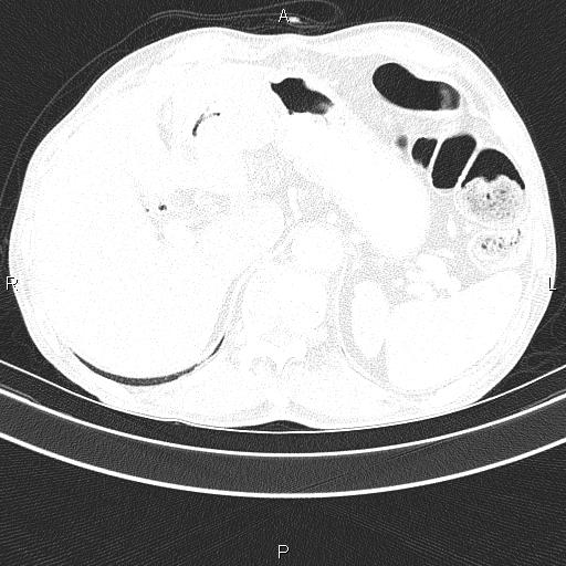 Ampullary adenocarcinoma (Radiopaedia 86093-102033 Axial lung window 54).jpg