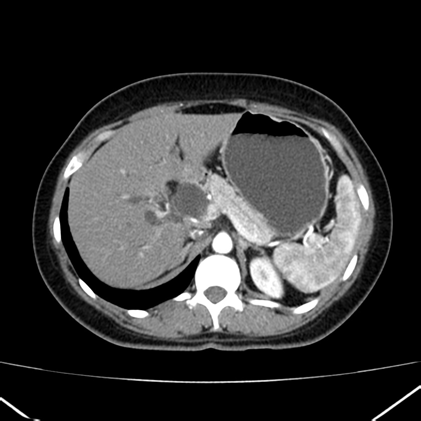 Ampullary tumor (Radiopaedia 22787-22816 B 25).jpg