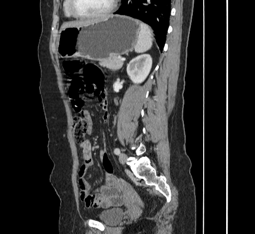 File:Ampullary tumor (Radiopaedia 60333-67998 C 39).jpg