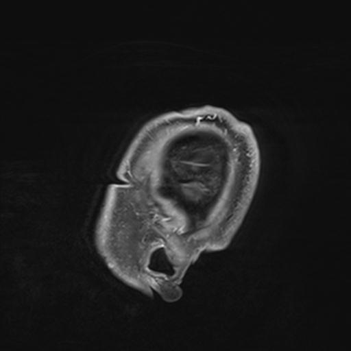 Amyloid angiopathy with inflammation (Radiopaedia 30360-31002 M 6).jpg