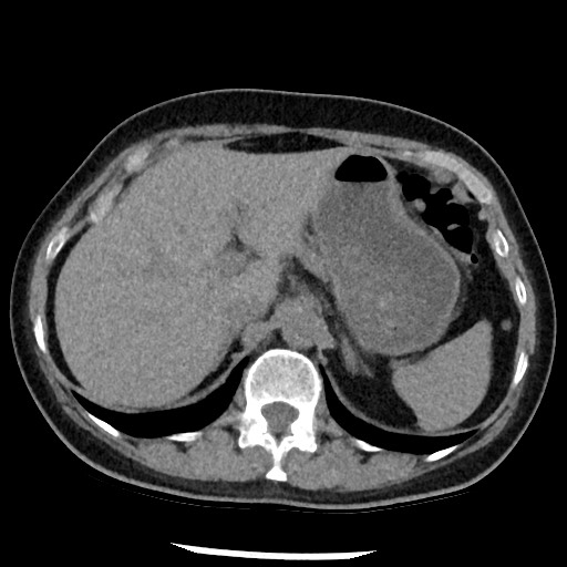 Amyloidosis - bronchial and diffuse nodular pulmonary involvement (Radiopaedia 60156-67744 Axial non-contrast 55).jpg