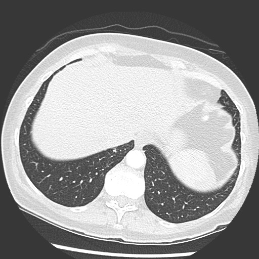 Amyloidosis - bronchial and diffuse nodular pulmonary involvement (Radiopaedia 60156-67745 Axial lung window 72).jpg