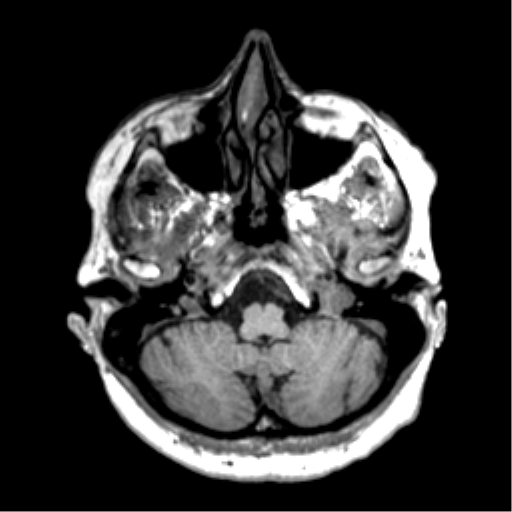 Anaplastic astrocytoma IDH wild-type (pseudoprogression) (Radiopaedia 42209-45277 Axial T1 22).png
