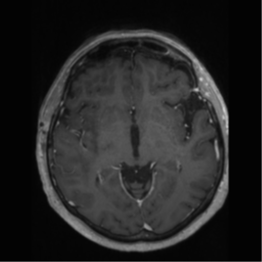 File:Anaplastic astrocytoma IDH wild-type (pseudoprogression) (Radiopaedia 42209-45277 Axial T1 C+ 56).png