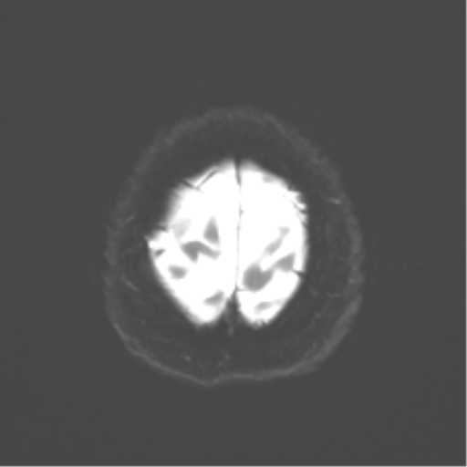 File:Anaplastic astrocytoma IDH wild-type (pseudoprogression) (Radiopaedia 42209-45279 Axial DWI 25).png