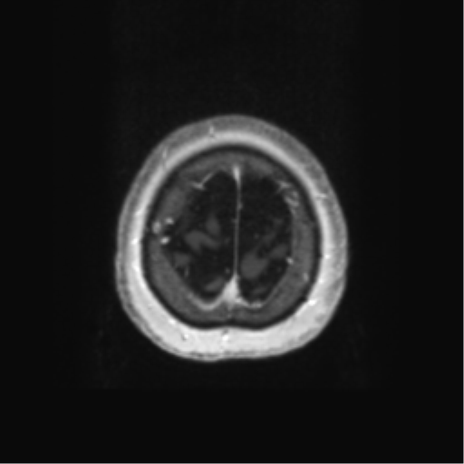 Anaplastic astrocytoma IDH wild-type (pseudoprogression) (Radiopaedia 42209-45279 Axial T1 C+ 131).png