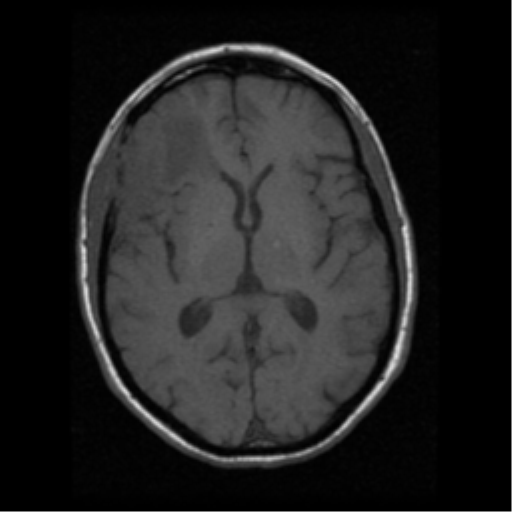 File:Anaplastic meningioma with recurrence (Radiopaedia 34452-35783 Axial T1 11).png