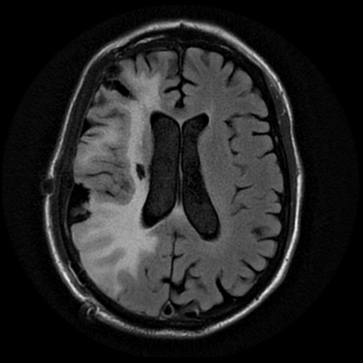 File:Anaplastic meningioma with recurrence (Radiopaedia 34452-35791 Axial FLAIR 13).png