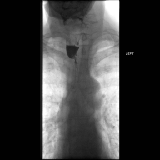 File:Anastomotic stricture post Ivor Lewis esophagectomy (Radiopaedia 47937-52715 Frontal 10).png