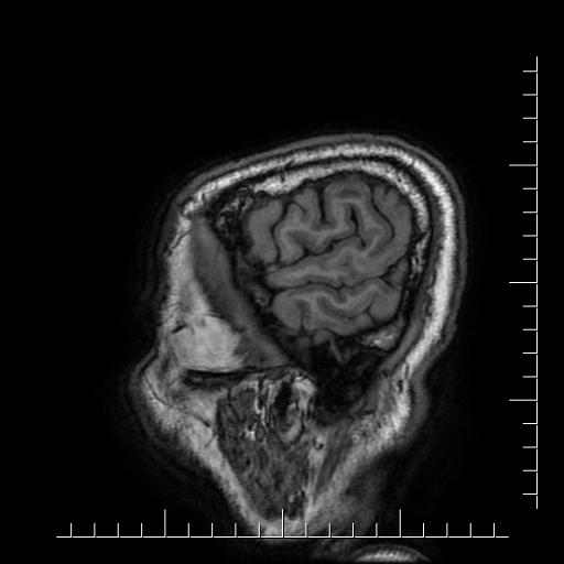 File:Aneurysm of posterior communicating artery (Radiopaedia 20188-20163 Sagittal T1 5).jpg