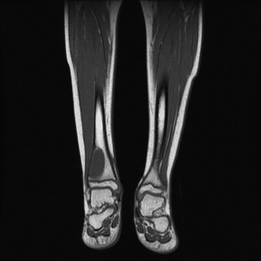 File:Aneurysmal bone cyst - tibia (Radiopaedia 22343-22367 Coronal T1 8).jpg