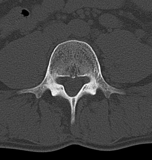 Aneurysmal bone cyst T11 (Radiopaedia 29294-29721 Axial bone window 100).jpg