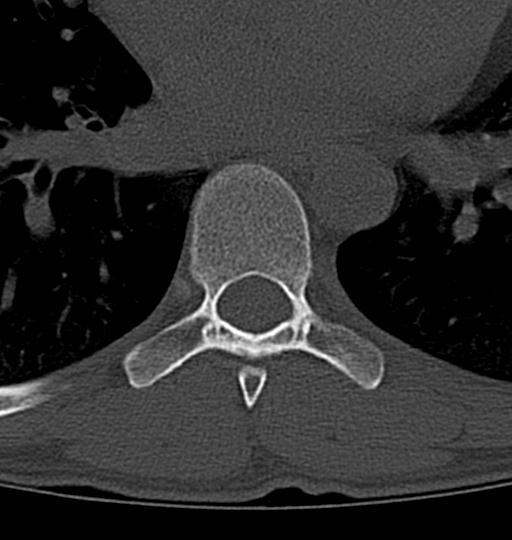 Aneurysmal bone cyst T11 (Radiopaedia 29294-29721 Axial bone window 13).jpg