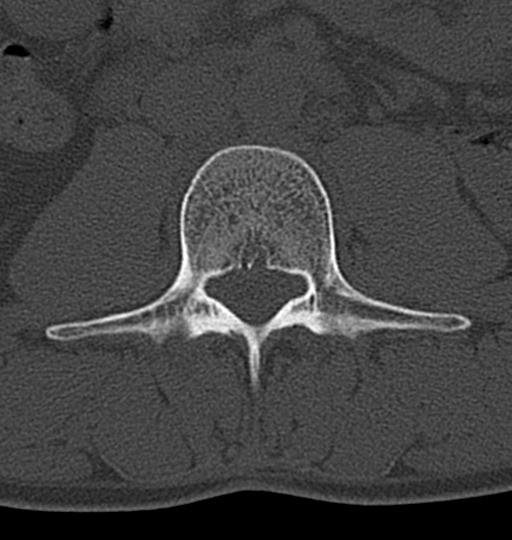 Aneurysmal bone cyst T11 (Radiopaedia 29294-29721 Axial bone window 88).jpg