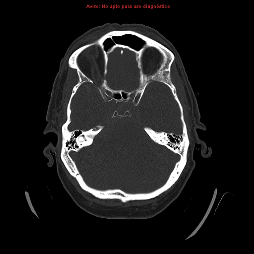 File:Aneurysmal subarachnoid hemorrhage (Radiopaedia 24740-24997 bone window 12).jpg