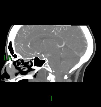 Aneurysmal subarachnoid hemorrhage with intra-axial extension (Radiopaedia 84371-99732 B 34).jpg