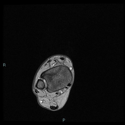 Ankle ganglion cyst (Radiopaedia 62809-71162 Axial Gradient Echo 77).jpg