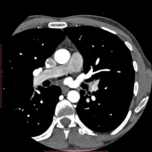 Anomalous left coronary artery from the pulmonary artery (ALCAPA) (Radiopaedia 70148-80181 A 15).jpg
