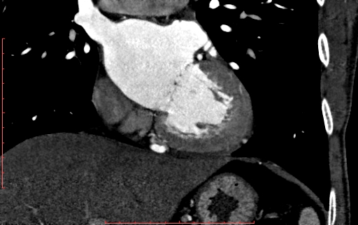Anomalous left coronary artery from the pulmonary artery (ALCAPA) (Radiopaedia 70148-80181 B 172).jpg