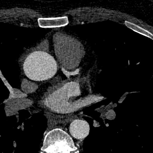 File:Anomalous origin of the left coronary artery with malignant course (Radiopaedia 77842-90126 C 16).jpeg