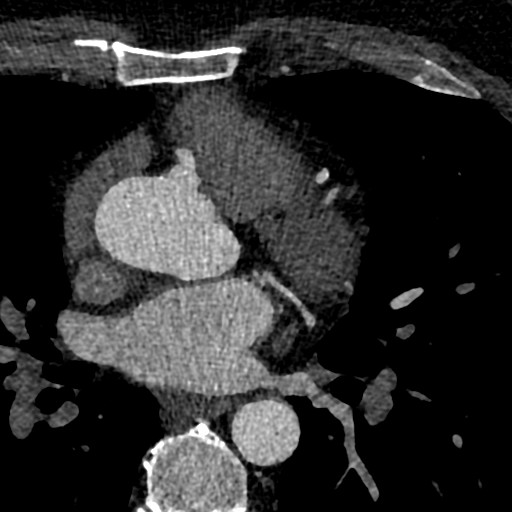 File:Anomalous origin of the left coronary artery with malignant course (Radiopaedia 77842-90126 C 53).jpeg
