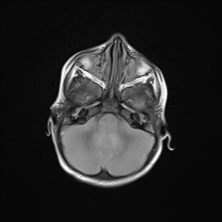File:Anoxic brain injury (Radiopaedia 79165-92139 Axial FLAIR 7).jpg