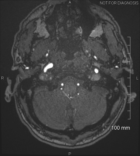 Anterior cerebral artery aneurysm (Radiopaedia 80683-94127 Axial MRA 20).jpg
