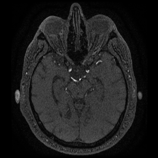 Anterior cerebral artery infarction (Radiopaedia 46794-51323 Axial MRA 79).jpg