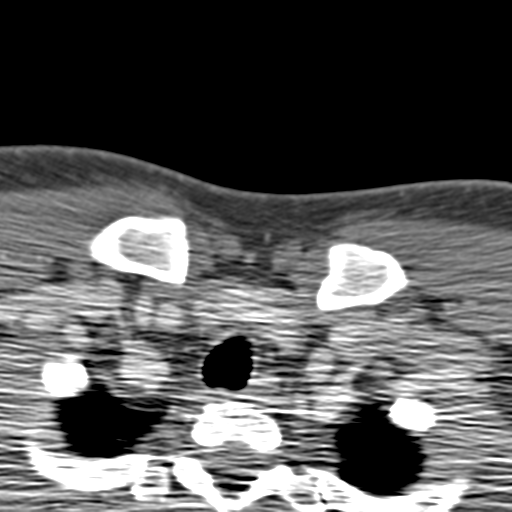 File:Anterior cerebral artery territory infarct (Radiopaedia 39327-41581 B 100).png