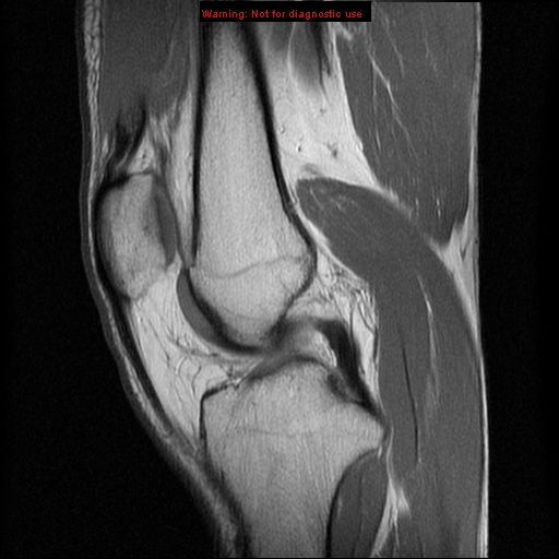 File:Anterior cruciate ligament injury - partial thickness tear (Radiopaedia 12176-12515 Sagittal PD 9).jpg